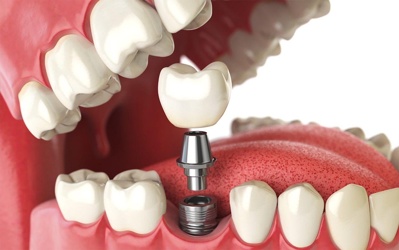 69011eeb4013446c6b3fd309_implante-dentario-preco-1-1